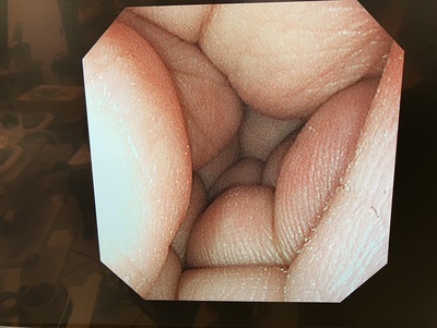 Video Gastroscope&nbsp;|&nbsp;OLYMPUS&nbsp;|&nbsp;GIF-XP290N