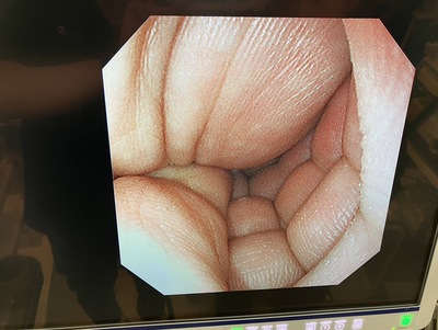 Video Gastroscope&nbsp;|&nbsp;OLYMPUS&nbsp;|&nbsp;GIF-XP290N