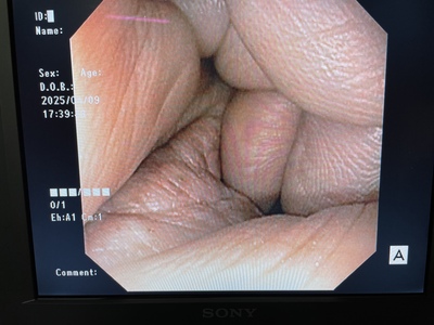 Video Gastroscope&nbsp;|&nbsp;OLYMPUS&nbsp;|&nbsp;GIF-XP170N