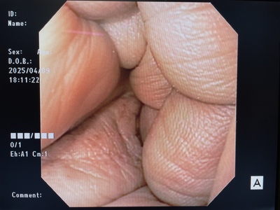 Video Gastroscope&nbsp;|&nbsp;OLYMPUS&nbsp;|&nbsp;GIF-140