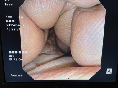 Video Gastroscope&nbsp;|&nbsp;OLYMPUS&nbsp;|&nbsp;GIF-XP150N