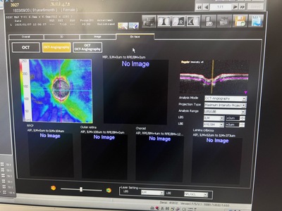  Optical Coherence Tomography ・OCT&nbsp;|&nbsp;NIDEK&nbsp;|&nbsp;RS-3000 Lite