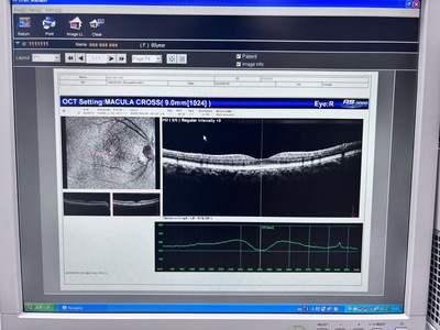 Optical Coherence Tomography ・OCT&nbsp;|&nbsp;NIDEK&nbsp;|&nbsp;RS-3000 Lite