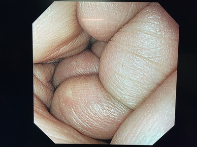 Video Gastroscope&nbsp;|&nbsp;OLYMPUS&nbsp;|&nbsp;GIF-XP290N