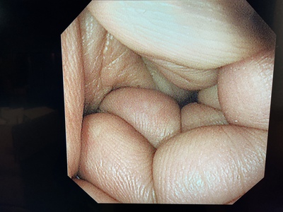 Video Gastroscope&nbsp;|&nbsp;OLYMPUS&nbsp;|&nbsp;GIF-XP290N