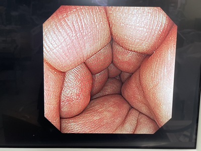 Video Colonoscope&nbsp;|&nbsp;OLYMPUS&nbsp;|&nbsp;CF-240I