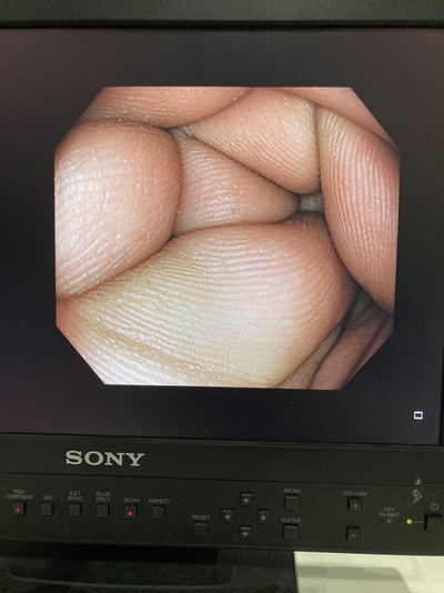 Video Colonoscope&nbsp;|&nbsp;OLYMPUS&nbsp;|&nbsp;PCF-H290ZI