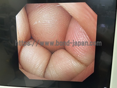 Video Gastroscope&nbsp;|&nbsp;OLYMPUS&nbsp;|&nbsp;GIF-XQ240