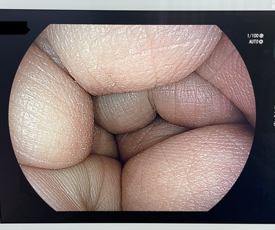 Gastroscope&nbsp;|&nbsp;FUJIFILM&nbsp;|&nbsp;EG-6600R