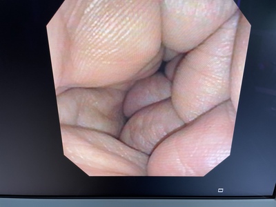 Video Gastroscope&nbsp;|&nbsp;OLYMPUS&nbsp;|&nbsp;GIF-XP150N