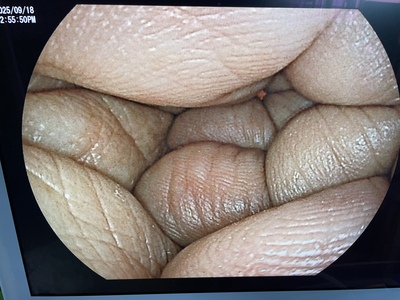 Video Gastroscope&nbsp;|&nbsp;Fujifilm&nbsp;|&nbsp;EG-L580NW7