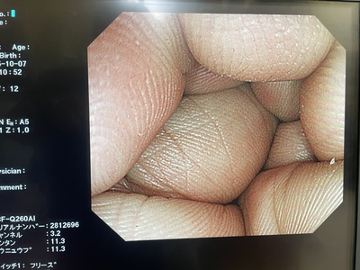 Video Colonoscope&nbsp;|&nbsp;OLYMPUS&nbsp;|&nbsp;PCF-Q260AI