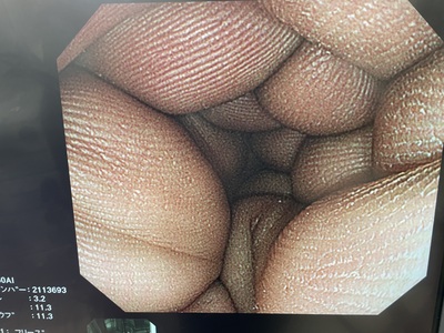 Video Colonoscope&nbsp;|&nbsp;OLYMPUS&nbsp;|&nbsp;CF-Q260AI