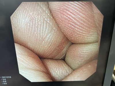 Video Gastroscope&nbsp;|&nbsp;OLYMPUS&nbsp;|&nbsp;GIF-XQ260