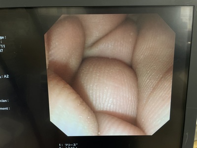 Video Duodenoscope&nbsp;|&nbsp;OLYMPUS&nbsp;|&nbsp;TJF-240