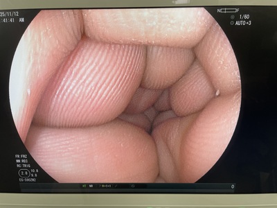 Gastroscope&nbsp;|&nbsp;FUJIFILM&nbsp;|&nbsp;EG-590ZW2