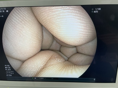 Bronchoscope&nbsp;|&nbsp;FUJIFILM&nbsp;|&nbsp;EB-530H