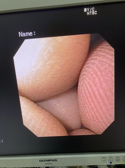 Video Gastroscope&nbsp;|&nbsp;OLYMPUS&nbsp;|&nbsp;GIF-130