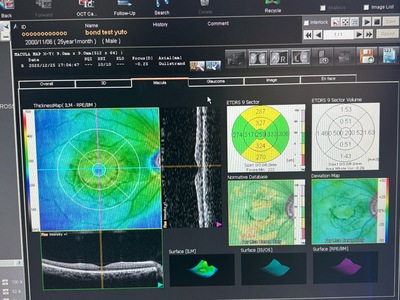 Optical Coherence Tomography ・OCT&nbsp;|&nbsp;NIDEK&nbsp;|&nbsp;RS-3000 Lite