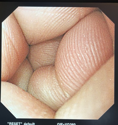 Video Gastroscope&nbsp;|&nbsp;OLYMPUS&nbsp;|&nbsp;GIF-XQ260