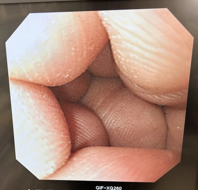 Video Gastroscope&nbsp;|&nbsp;OLYMPUS&nbsp;|&nbsp;GIF-XP260