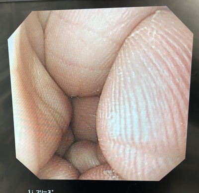 Video Gastroscope&nbsp;|&nbsp;OLYMPUS&nbsp;|&nbsp;GIF-XQ240