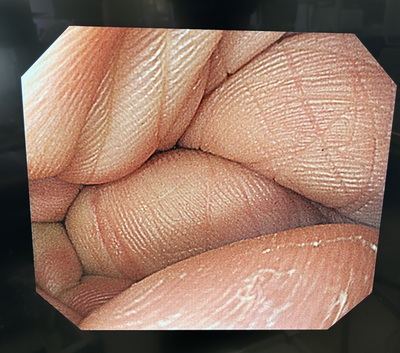 Video Gastroscope&nbsp;|&nbsp;OLYMPUS&nbsp;|&nbsp;GIF-Q260