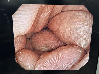 Video Colonoscope&nbsp;|&nbsp;OLYMPUS&nbsp;|&nbsp;CF-Q260AI