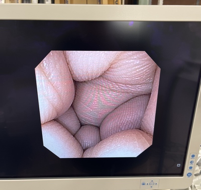 Video Gastroscope&nbsp;|&nbsp;OLYMPUS&nbsp;|&nbsp;GIF-XP170N