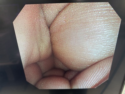 Video Gastroscope&nbsp;|&nbsp;OLYMPUS&nbsp;|&nbsp;GIF-XP260N