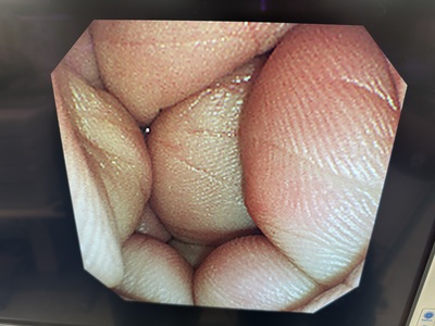 Video Gastroscope&nbsp;|&nbsp;OLYMPUS&nbsp;|&nbsp;GIF-XP260N