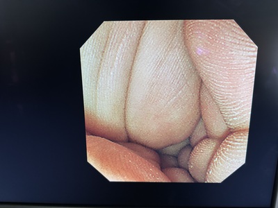 Video Duodenoscope&nbsp;|&nbsp;OLYMPUS&nbsp;|&nbsp;TJF-260V