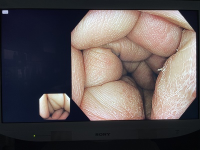 Video Colonoscope&nbsp;|&nbsp;OLYMPUS&nbsp;|&nbsp;PCF-H290ZI
