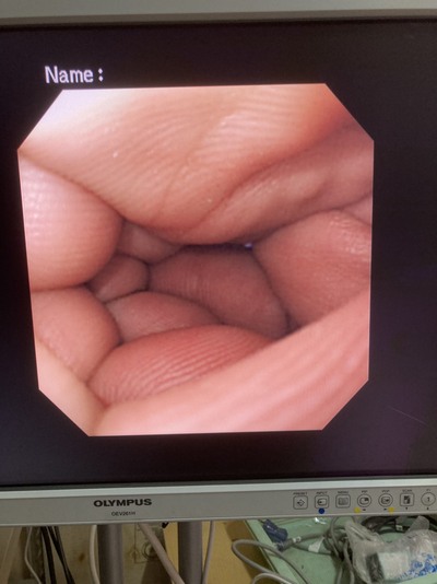Video Gastroscope&nbsp;|&nbsp;OLYMPUS&nbsp;|&nbsp;GIF-XQ240