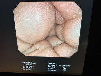 Video Colonoscope&nbsp;|&nbsp;OLYMPUS&nbsp;|&nbsp;CF-H260AI