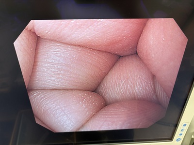 Video Gastroscope&nbsp;|&nbsp;OLYMPUS&nbsp;|&nbsp;GIF-H260