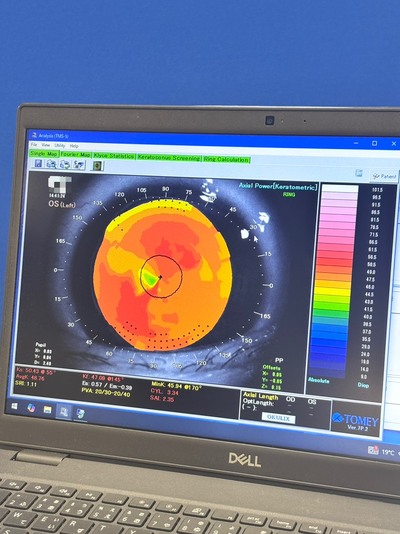 Placido Topography Meets 3-D Scheimpflug Imaging—A Hybrid Anterior Segment Analyzer Capturing the Full Corneal Profile in 0.5 Seconds.&nbsp;|&nbsp;TOMEY&nbsp;|&nbsp;TMS-5