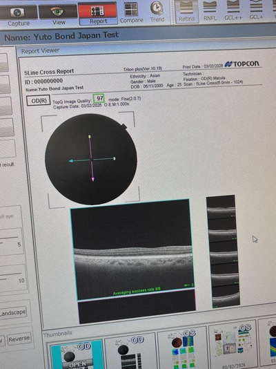OCT With Angiography&nbsp;|&nbsp;TOPCON&nbsp;|&nbsp;DRI OCT Triton plus