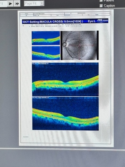 ENTRY Model of OCT&nbsp;|&nbsp;NIDEK&nbsp;|&nbsp;RS-3000 Lite