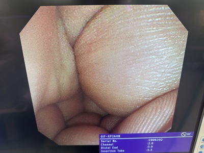 Video Gastroscope&nbsp;|&nbsp;OLYMPUS&nbsp;|&nbsp;GIF-XP260N