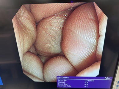 Video Gastroscope&nbsp;|&nbsp;OLYMPUS&nbsp;|&nbsp;GIF-XP260N