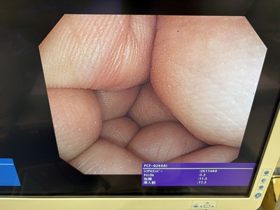 Video Colonoscope&nbsp;|&nbsp;OLYMPUS&nbsp;|&nbsp;PCF-Q260AI