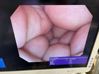Video Colonoscope&nbsp;|&nbsp;OLYMPUS&nbsp;|&nbsp;PCF-Q260AI