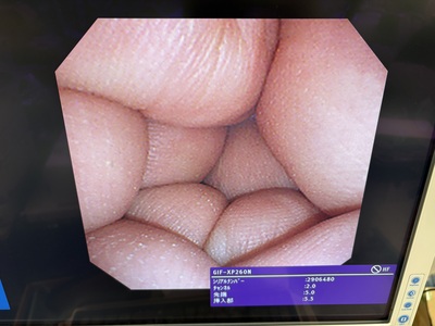 Video Gastroscope&nbsp;|&nbsp;OLYMPUS&nbsp;|&nbsp;GIF-XP260N