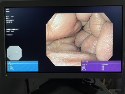 CV-170 + GIFH170 Endoscope Set&nbsp;|&nbsp;OLYMPUS&nbsp;|&nbsp;GIF-H170