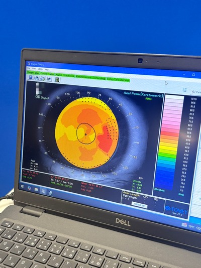 Placido Topography Meets 3-D Scheimpflug Imaging—A Hybrid Anterior Segment Analyzer Capturing the Full Corneal Profile in 0.5 Seconds.&nbsp;|&nbsp;TOMEY&nbsp;|&nbsp;TMS-5