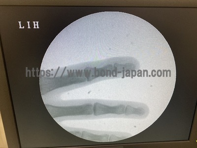 Mobile C-Arm&nbsp;|&nbsp;CANON&nbsp;|&nbsp;SXT-1000A