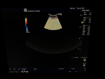 Color Doppler&nbsp;|&nbsp;GE&nbsp;|&nbsp;LOGIQ V5 Expert