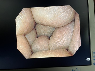 CV-170 + GIF-H170&nbsp;|&nbsp;OLYMPUS&nbsp;|&nbsp;GIF-H170