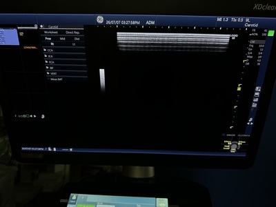 Color Doppler&nbsp;|&nbsp;GE&nbsp;|&nbsp;Logiq S8 XDclear
